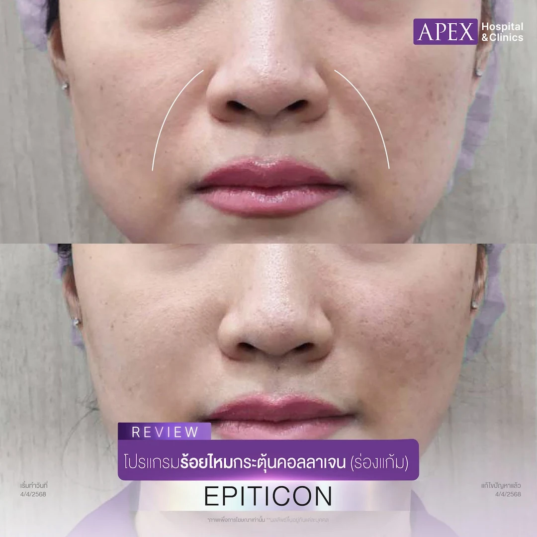 รีวิวร้อยไหมร่องแก้ม Program Epiticon