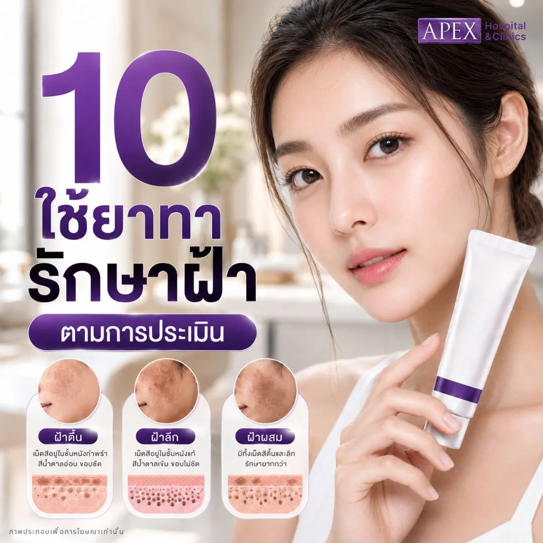 วิธีรักษาฝ้า ใช้ยาทารักษาฝ้า