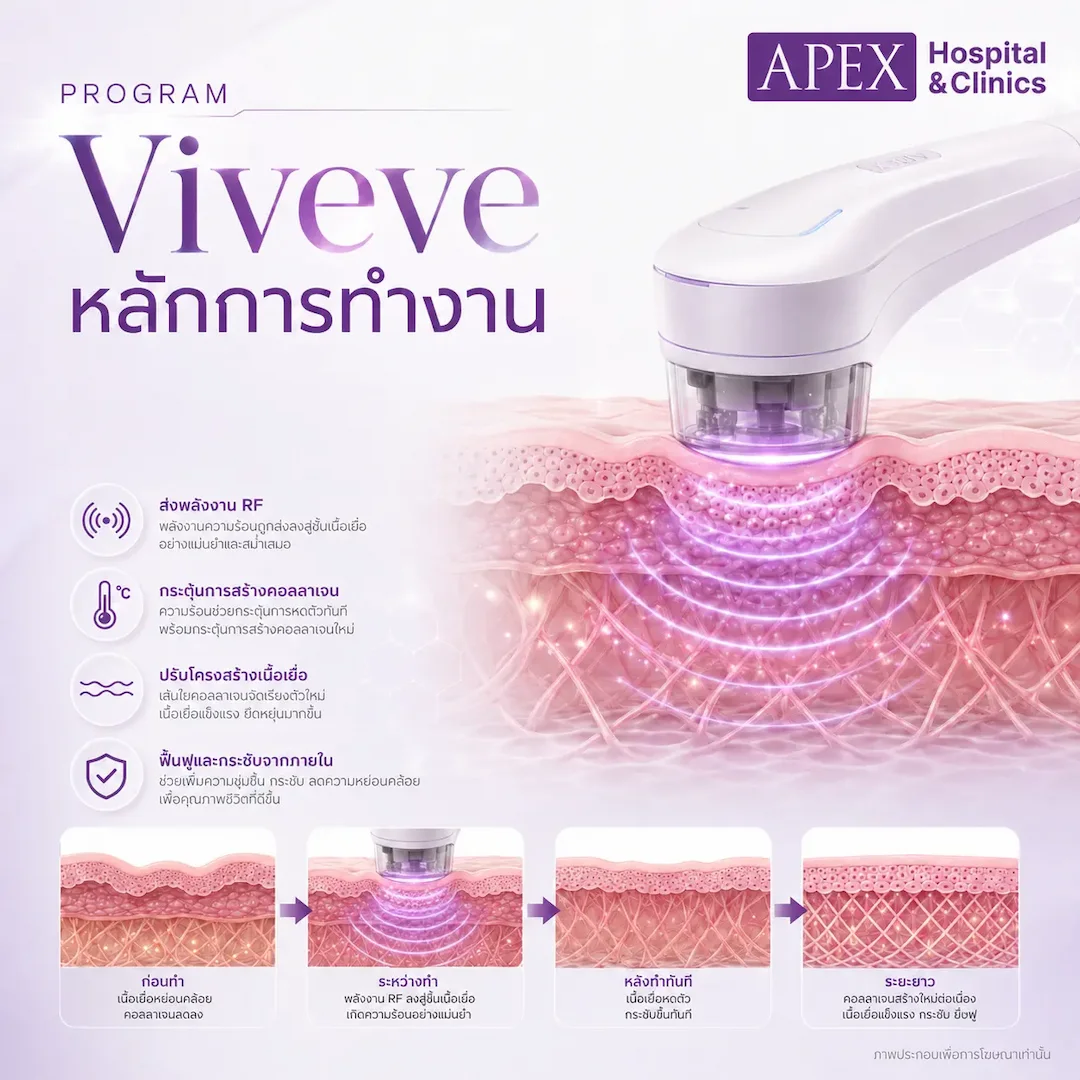 หลักการทำงานเครื่อง Viveve