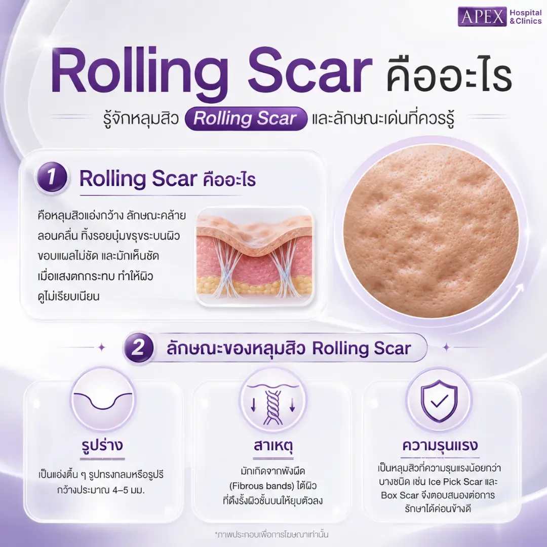 หลุมสิว Rolling Scar คืออะไร