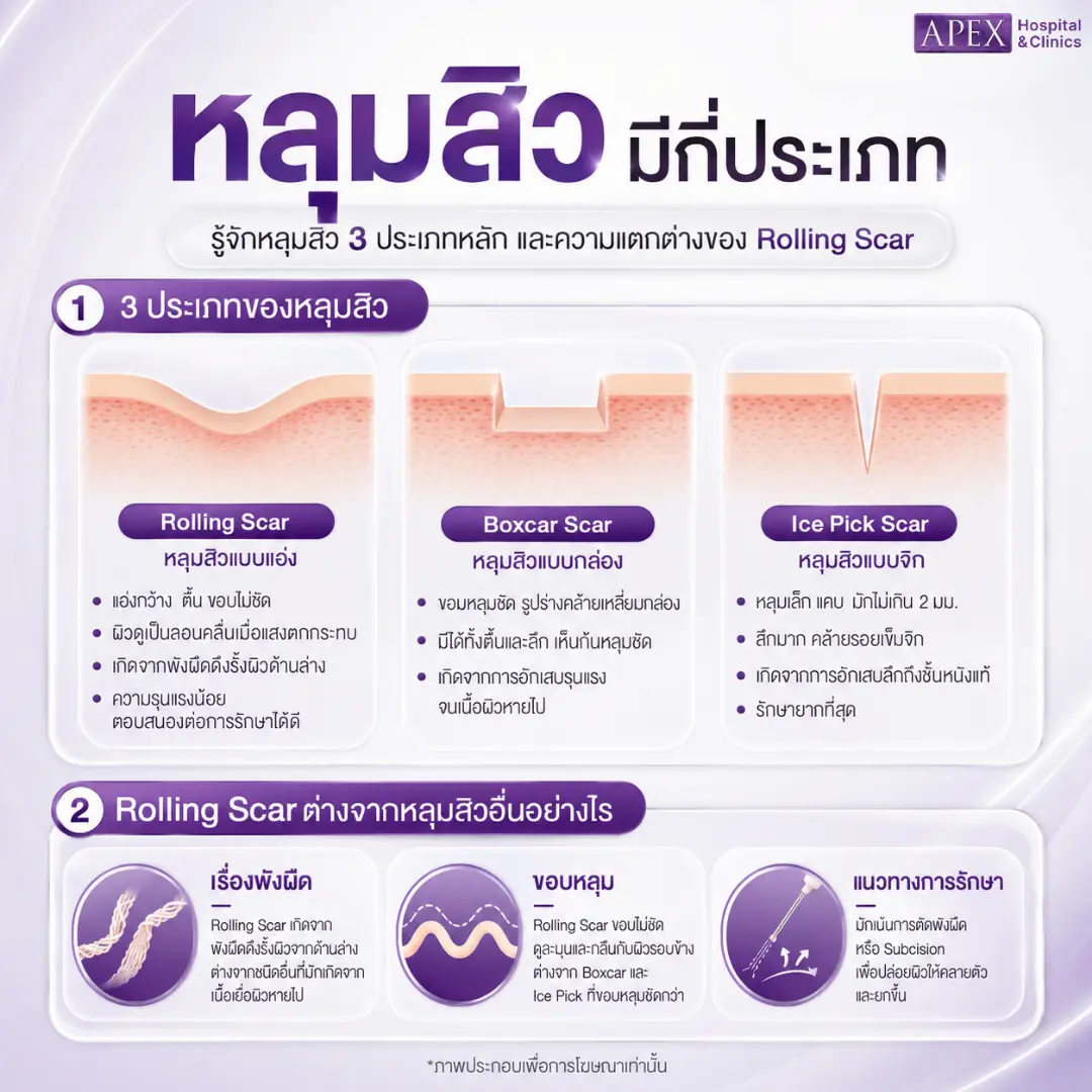 หลุมสิวแบบ Rolling Scar vs หลุมสิวแบบอื่น