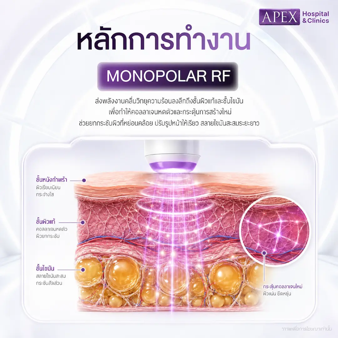 Monopolar RF ทำงานอย่างไร