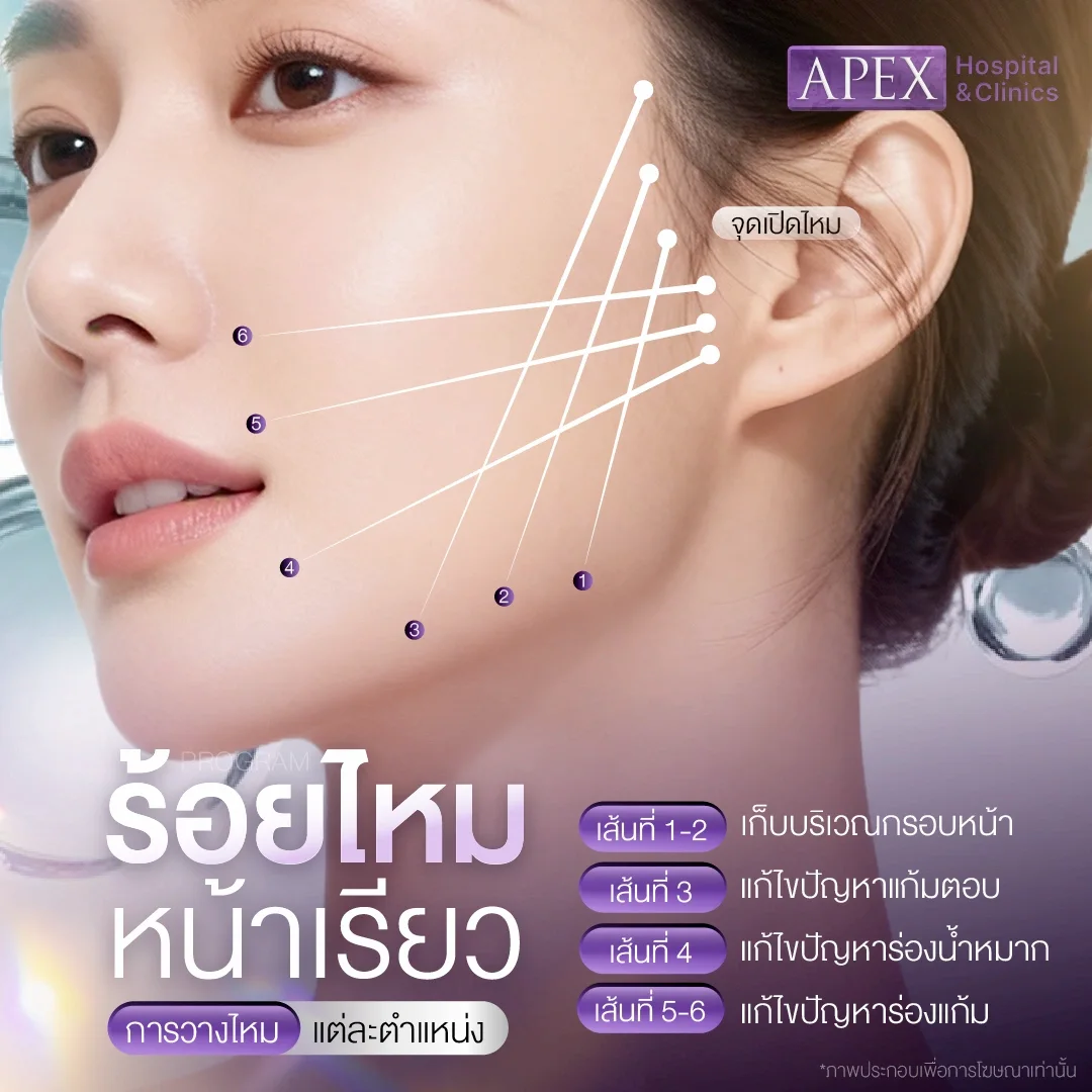 การวางตำแหน่งของการร้อยไหมหน้าเรียว