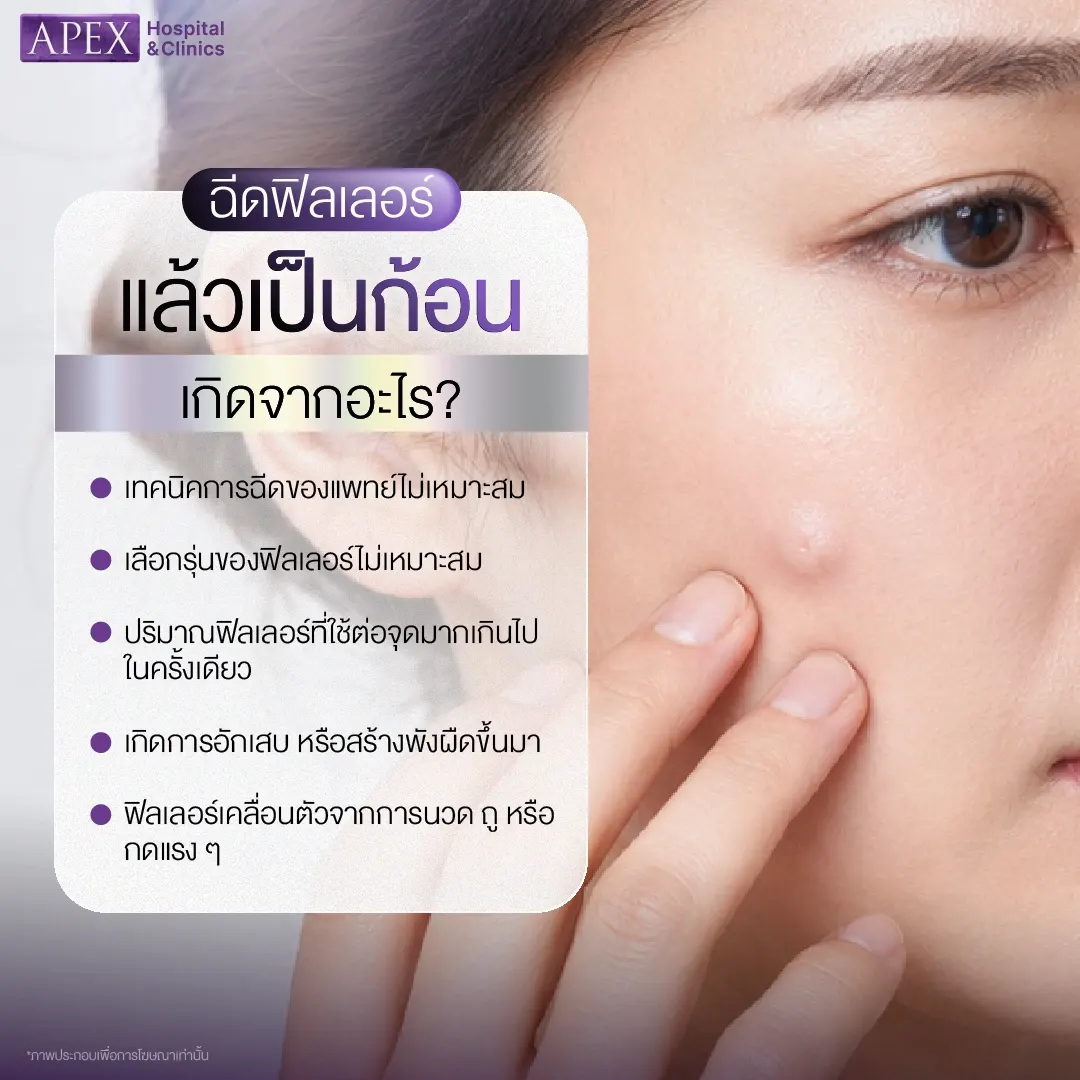 ฉีดฟิลเลอร์แล้วเป็นก้อน เกิดจากอะไร