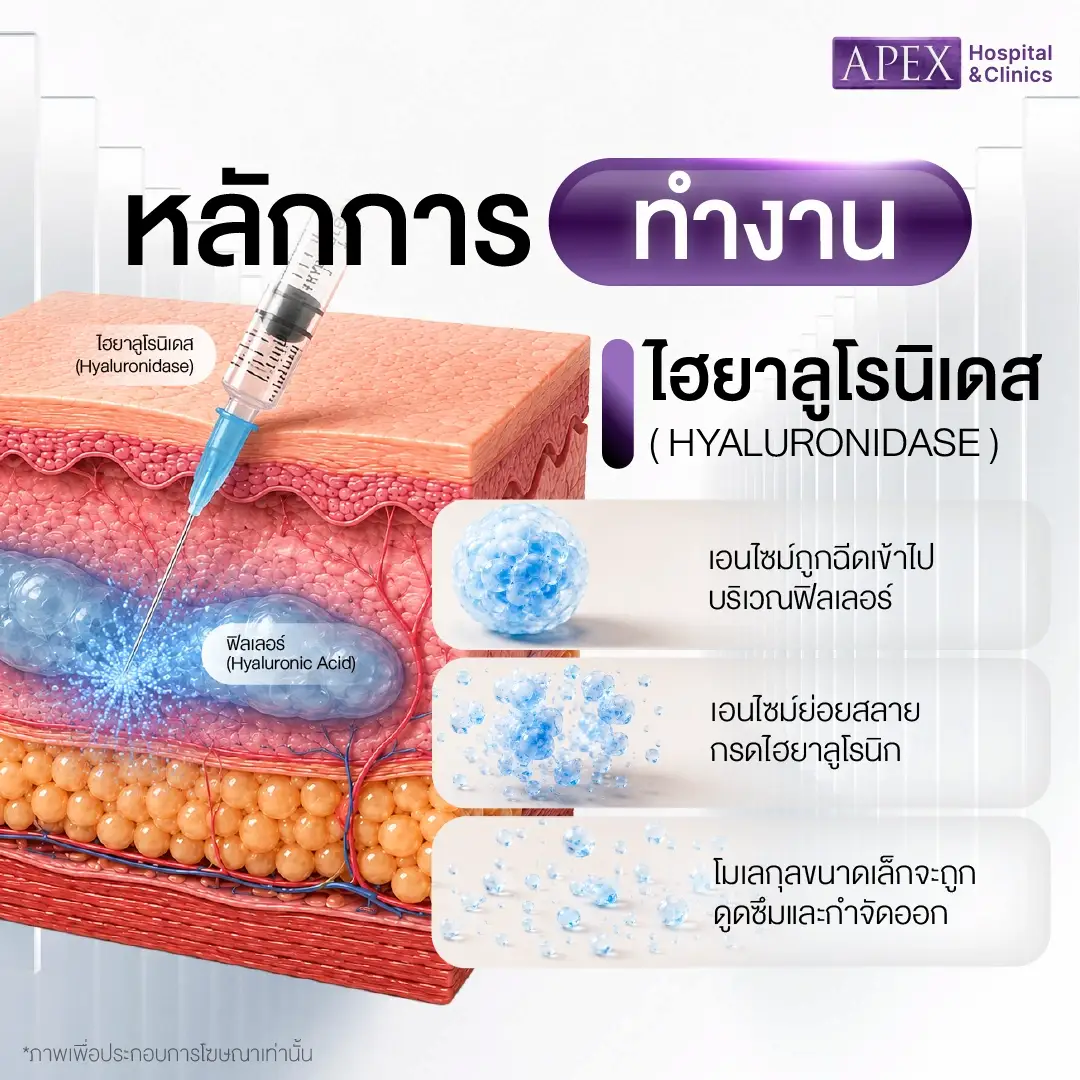 ฉีดสลายฟิลเลอร์ มีหลักการทำงานอย่างไร