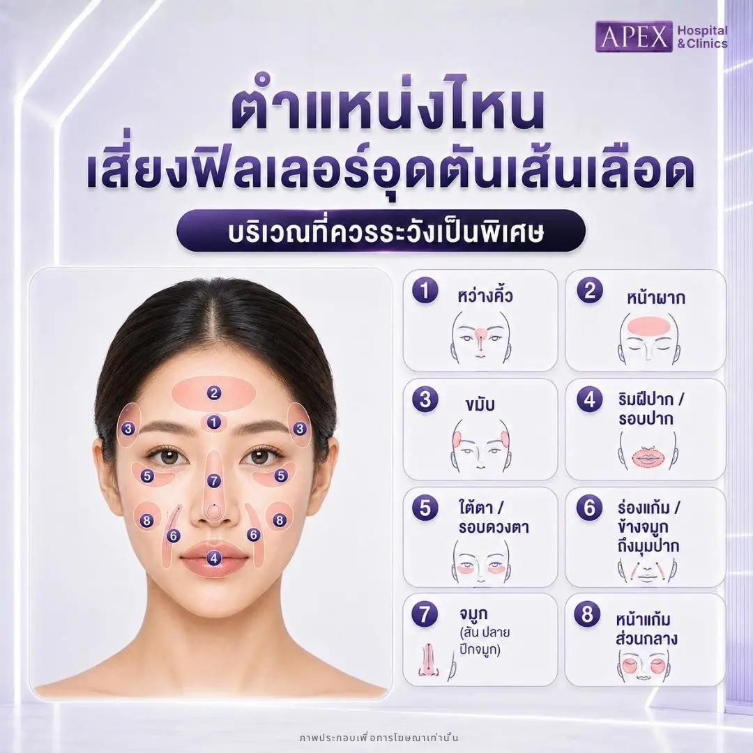 ตำแหน่งไหนเสี่ยงฟิลเลอร์อุดตันเส้นเลือด