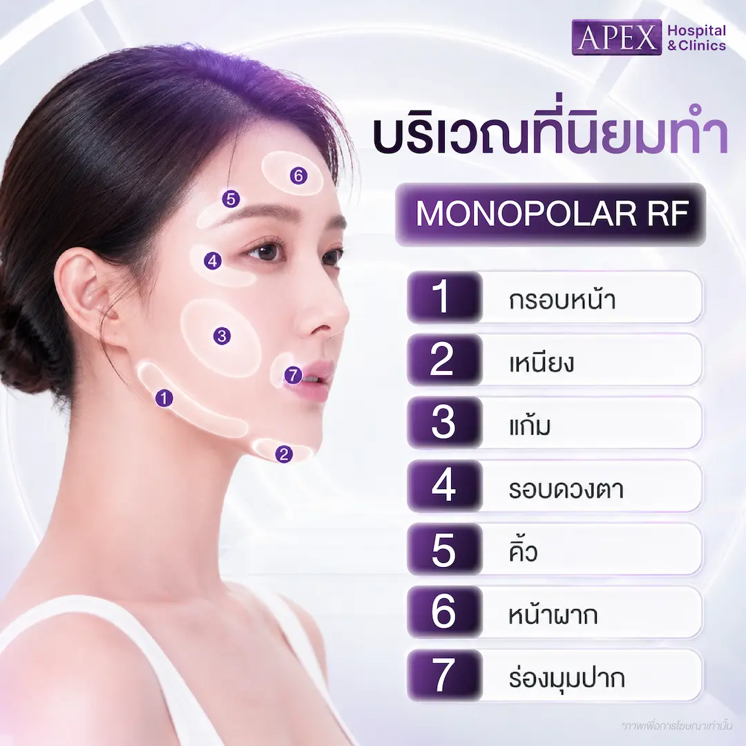 บริเวณที่นิยมทำ Monopolar RF