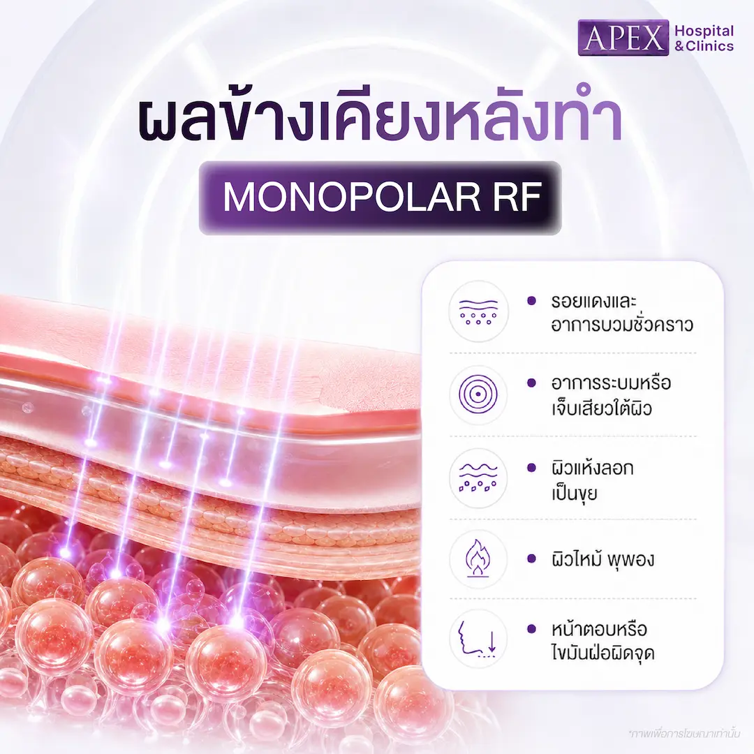 ผลข้างเคียงที่อาจเกิดขึ้นหลังทำ Monopolar RF
