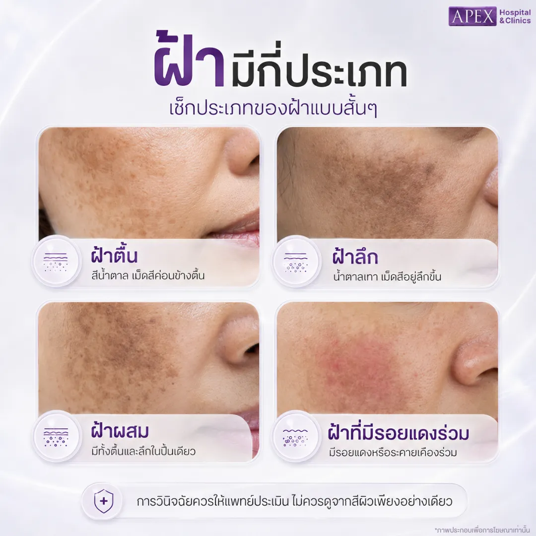 ฝ้า มีกี่ประเภท