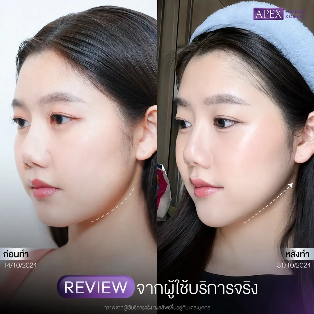 รีวิวฉีดโบท็อกลดกราม