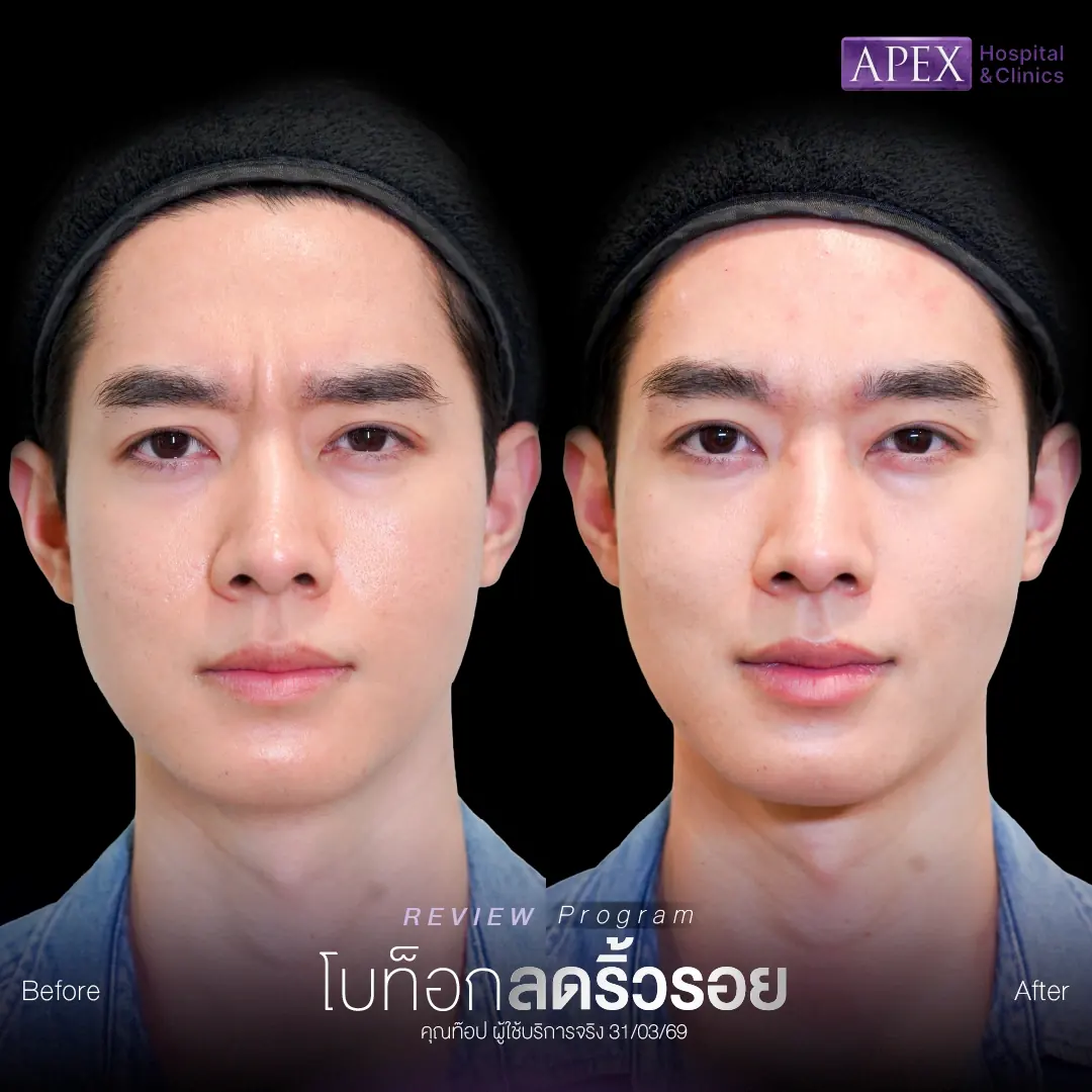 รีวิวฉีดโบท็อกลดริ้วรอย