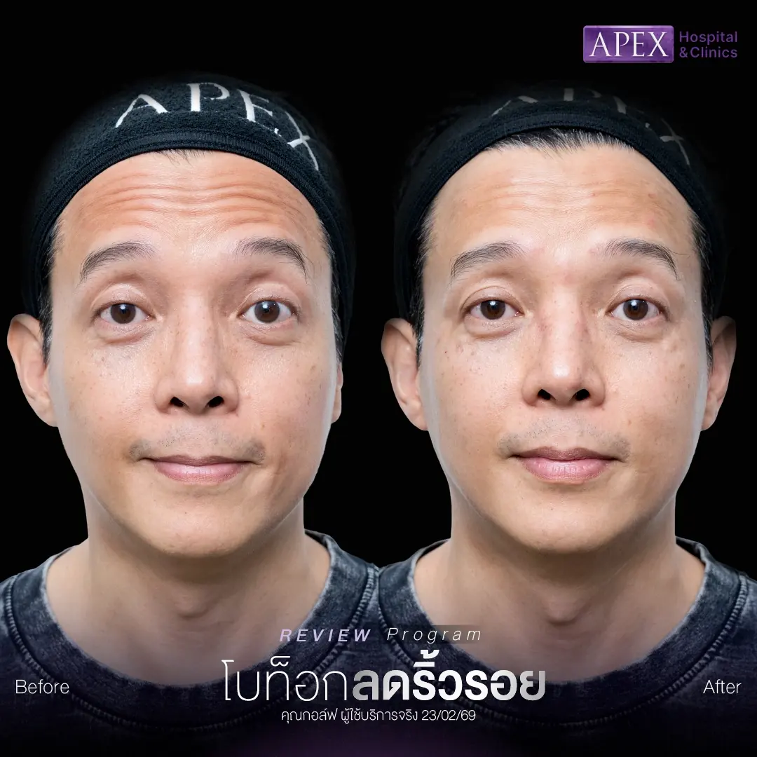 รีวิวฉีดโบท็อกลดริ้วรอยหน้าผาก