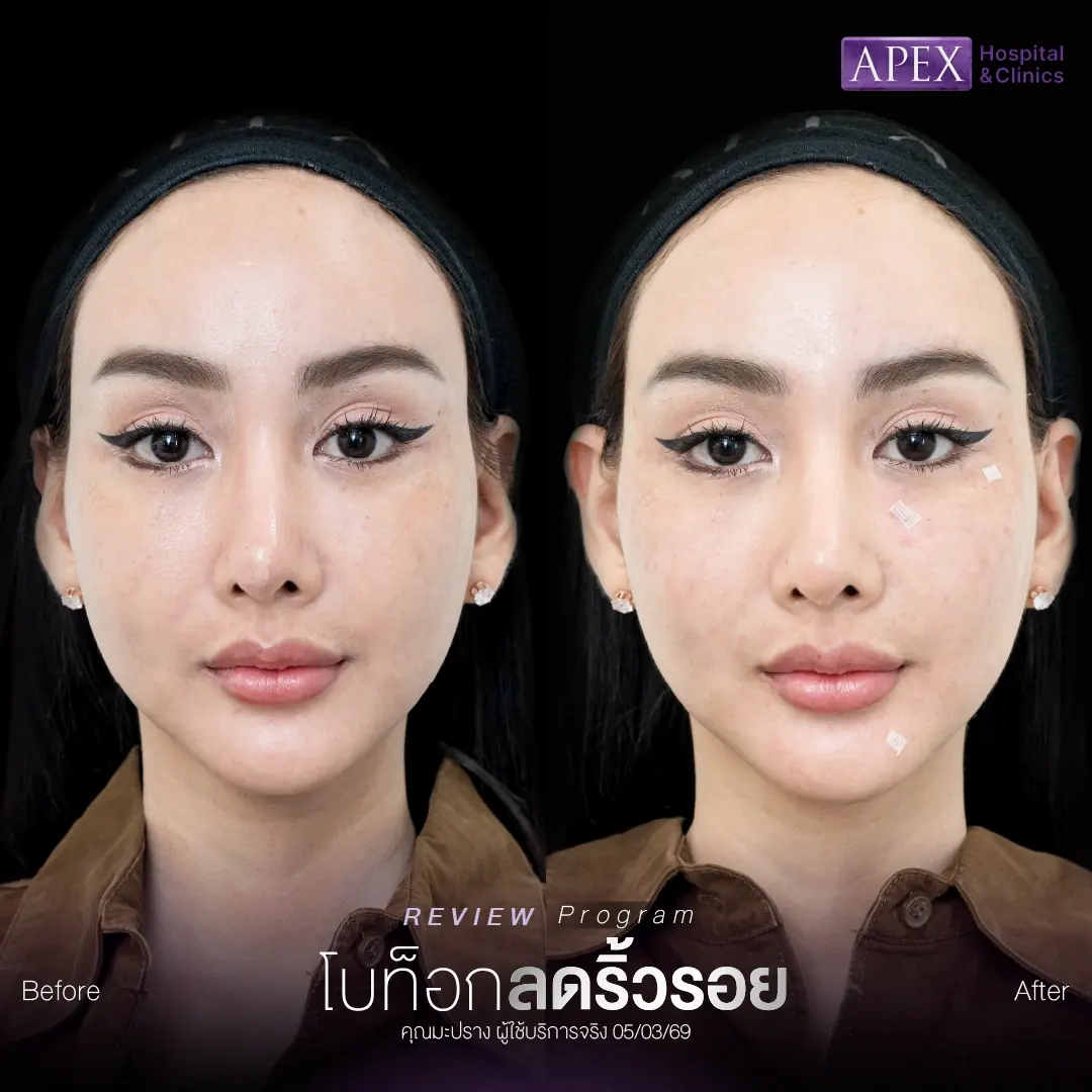 รีวิวฉีดโบท็อกเก็บริ้วรอย