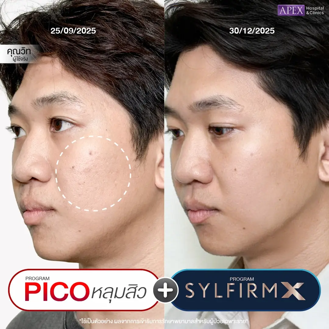 รีวิวรักษาหลุมสิว ที่ APEX