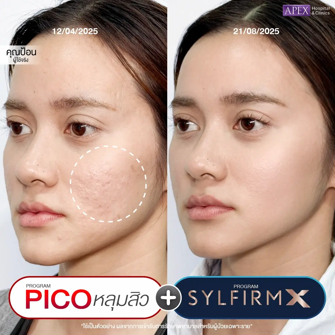 รีวิวรักษาหลุมสิว ที่ APEX