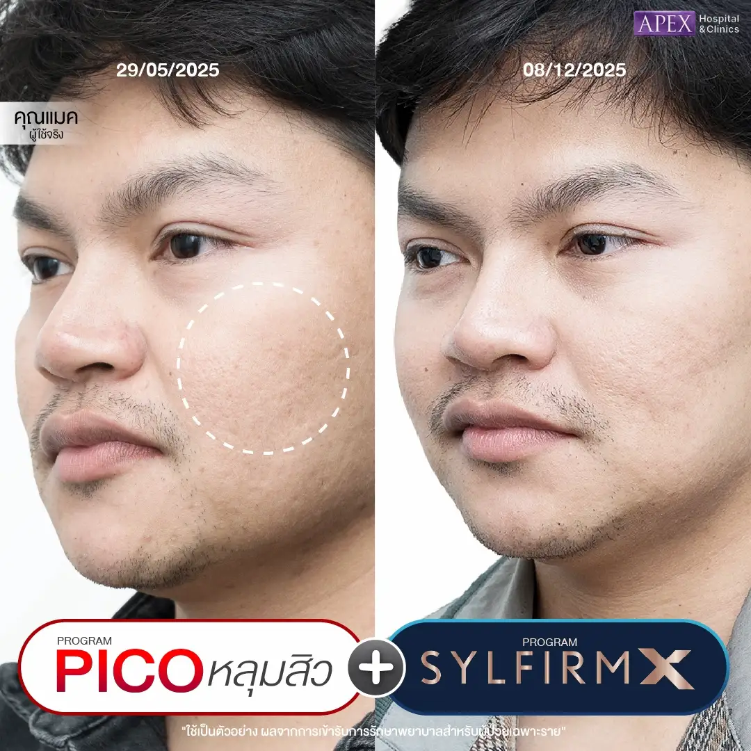 รีวิวรักษาหลุมสิว ที่ APEX