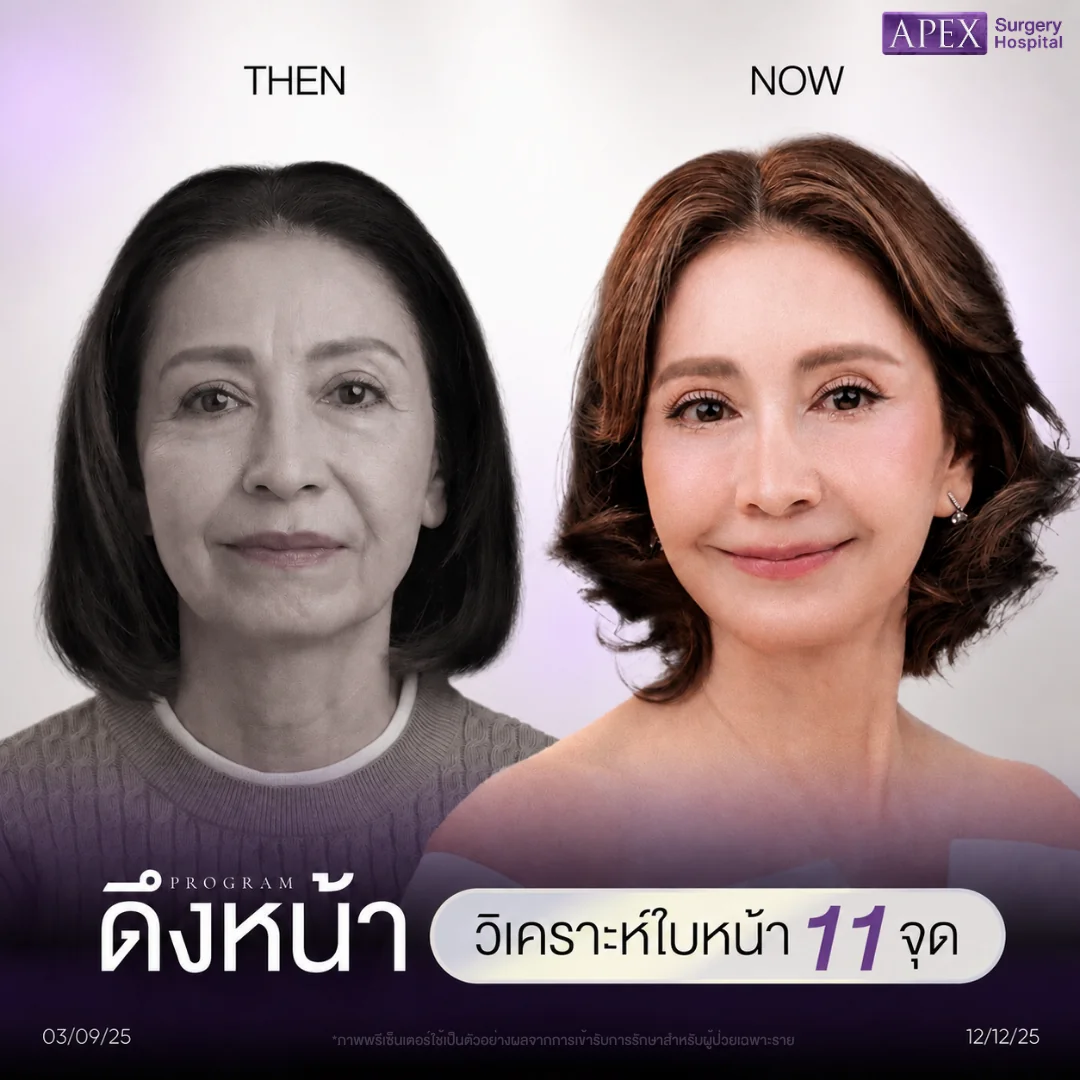 รีวิวศัลยกรรมดึงหน้า รักษาร่องน้ำหมาก