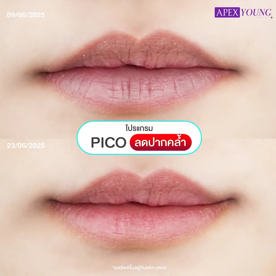 รีวิวเลเซอร์ปากคล้ำ