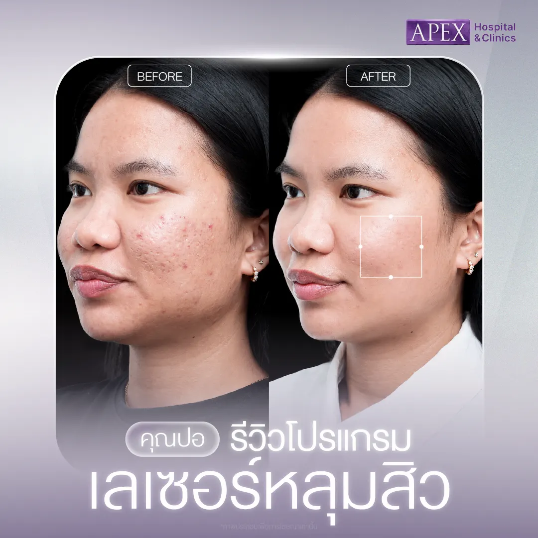 รีวิวเลเซอร์หลุมสิว
