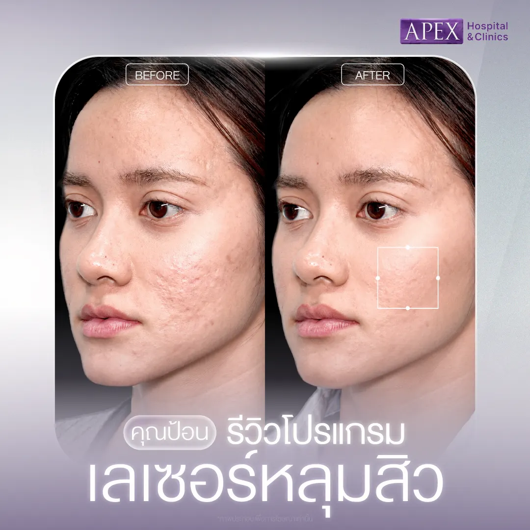 รีวิวเลเซอร์หลุมสิว