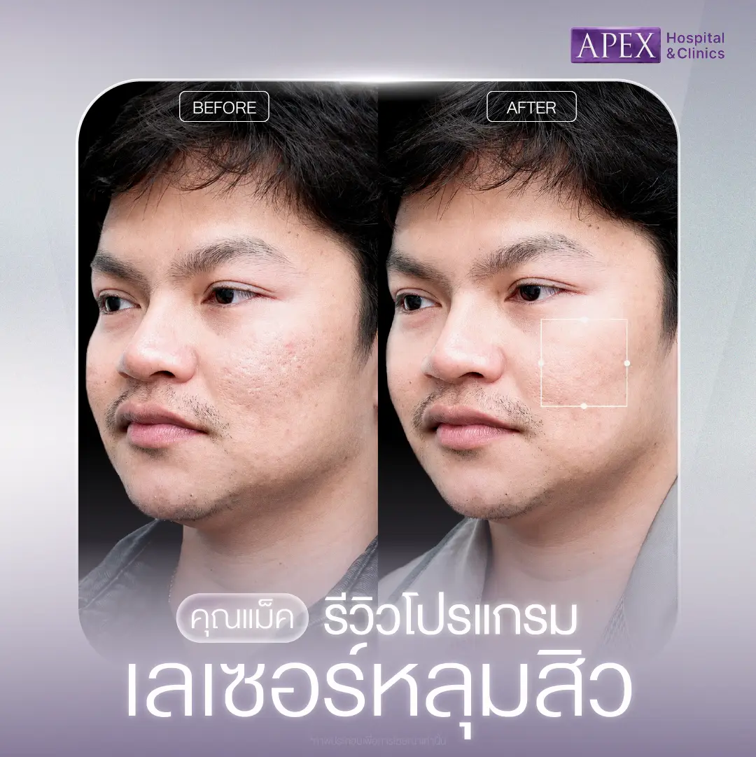 รีวิวเลเซอร์หลุมสิว
