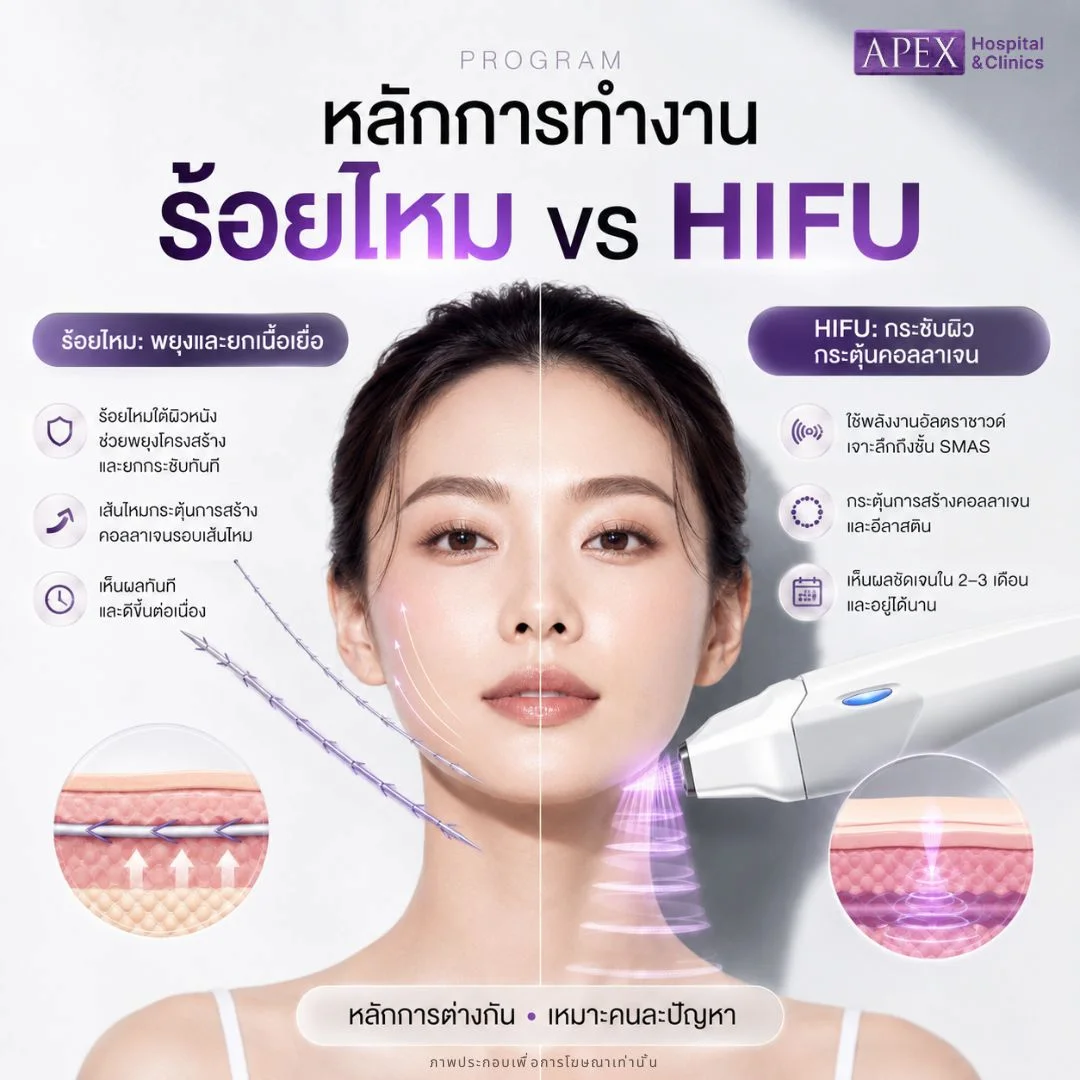 ร้อยไหม vs HIFU ต่างกันอย่างไร
