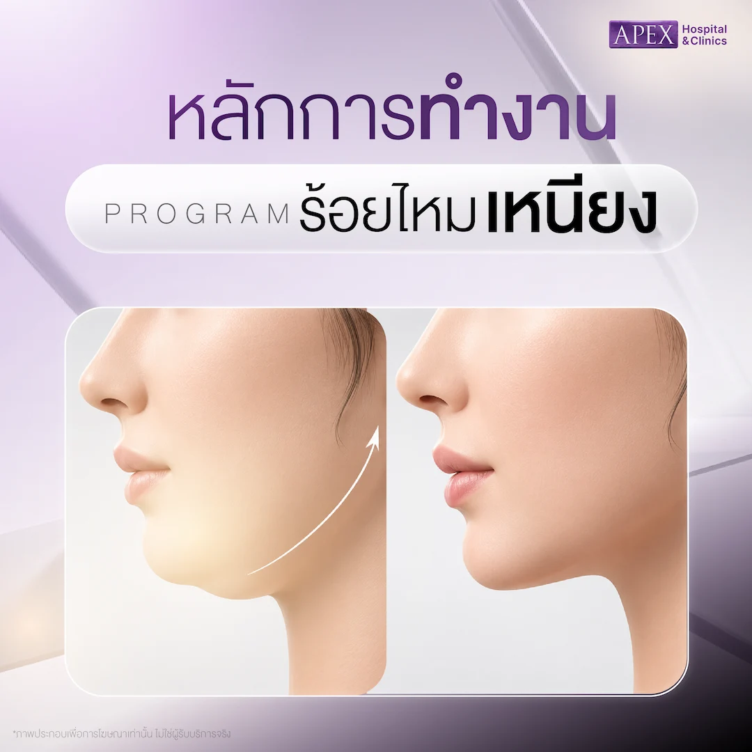 ร้อยไหมเหนียง ช่วยลดเหนียงได้อย่างไร