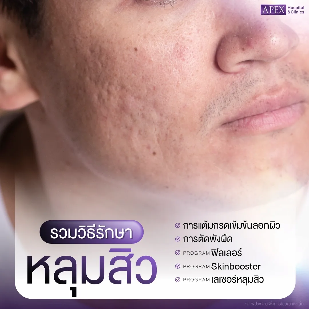 วิธีรักษาหลุมสิว
