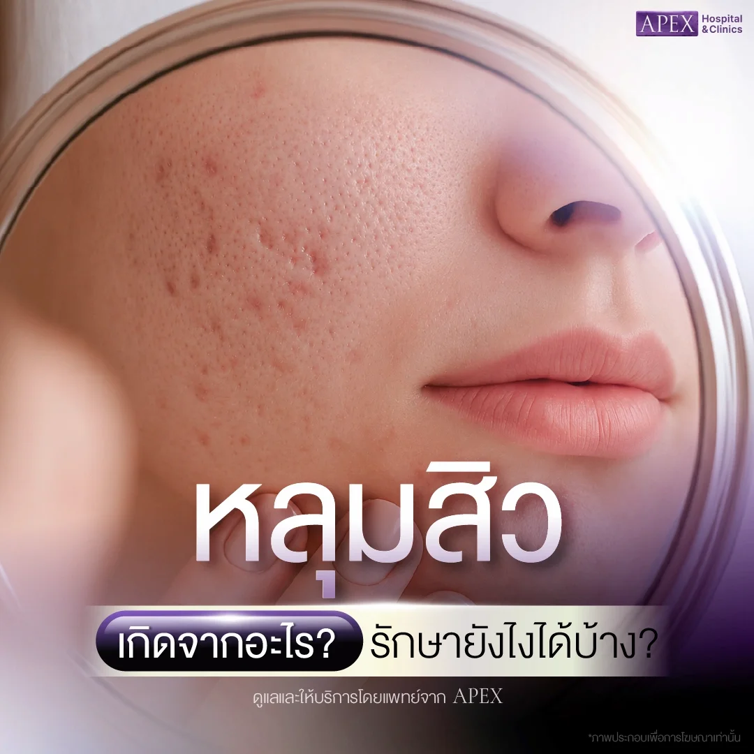 หลุมสิว มีกี่แบบ เกิดจากอะไร