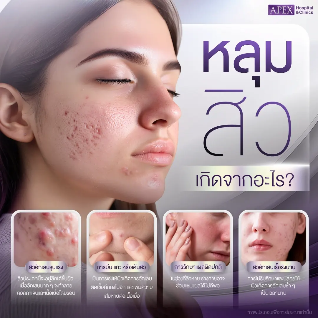 หลุมสิว เกิดจากอะไร