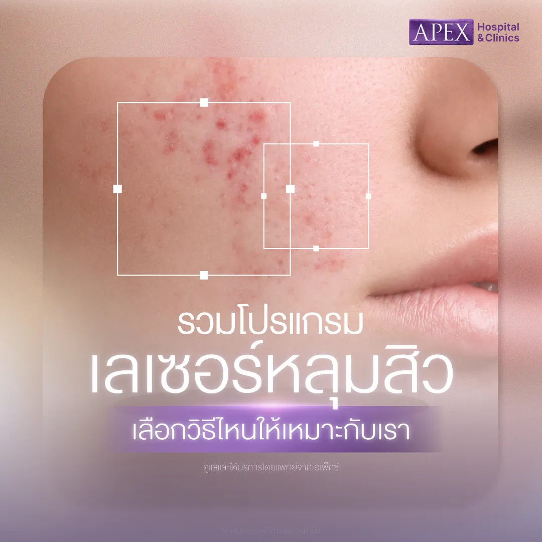 เลเซอร์หลุมสิว