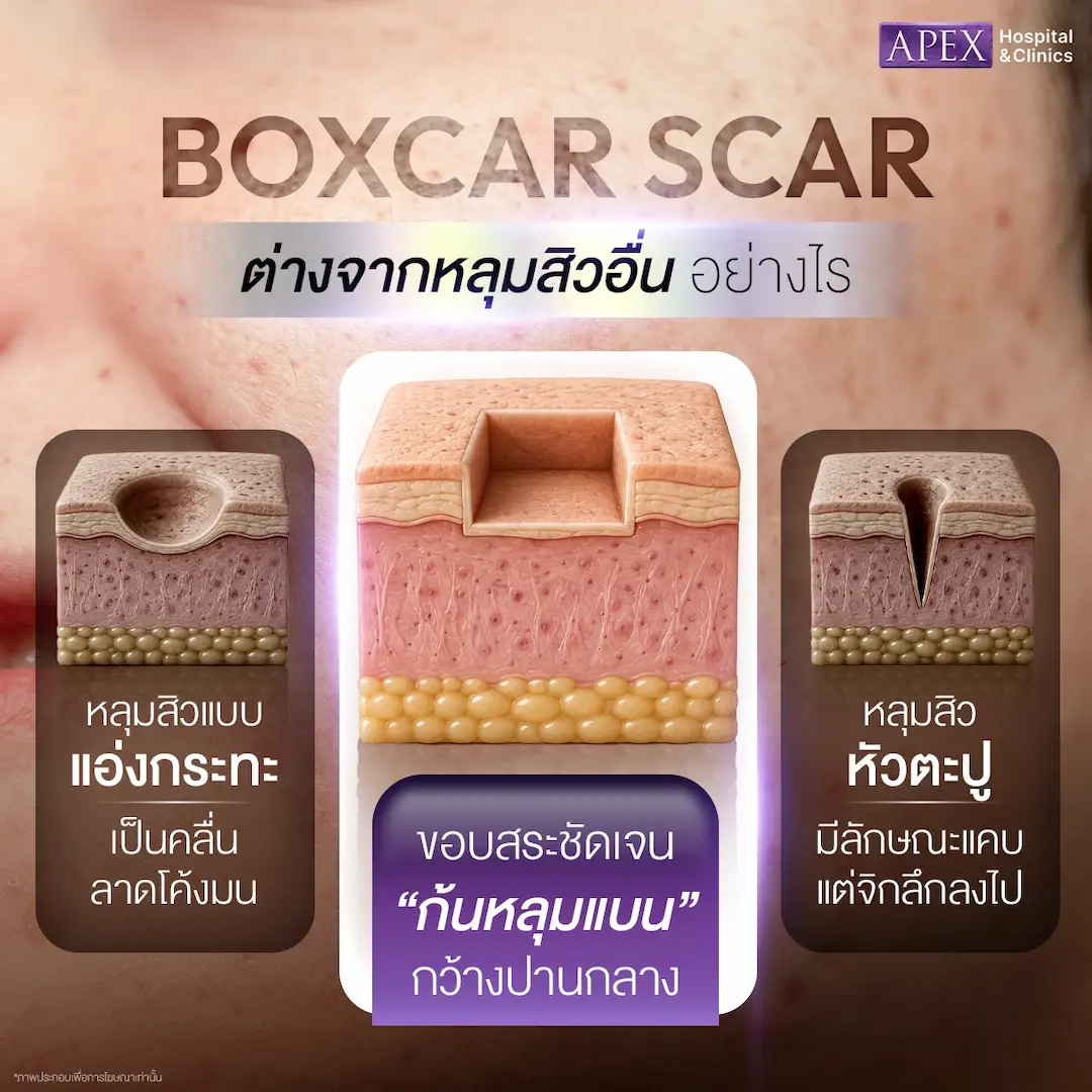 Boxcar Scar ต่างจากหลุมสิวประเภทอื่นอย่างไร