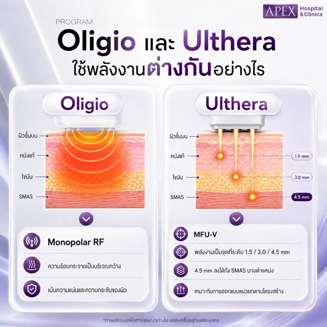 Oligio Vs Ulthera