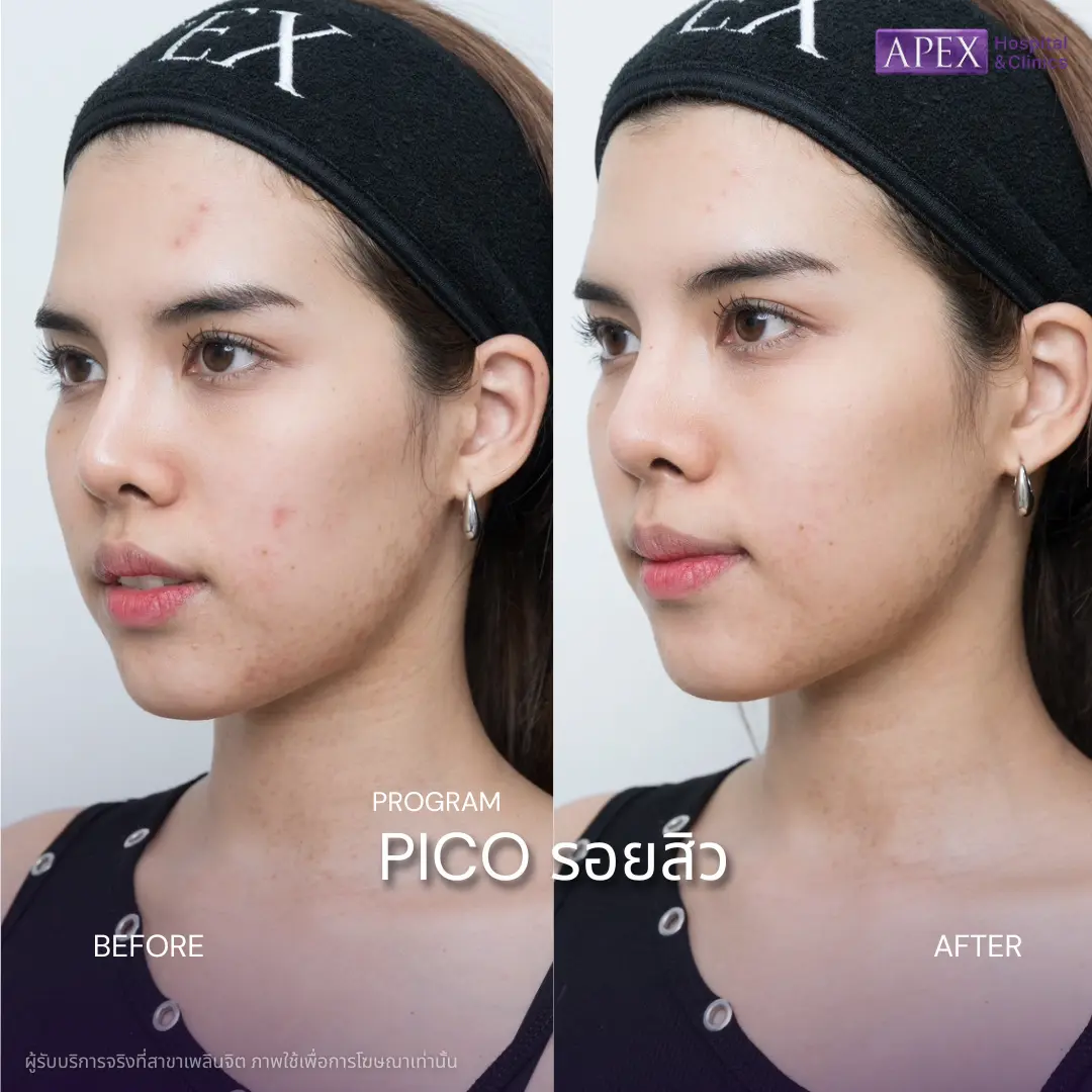 PICO Laser ลดรอยสิว ให้ผิวเนียน