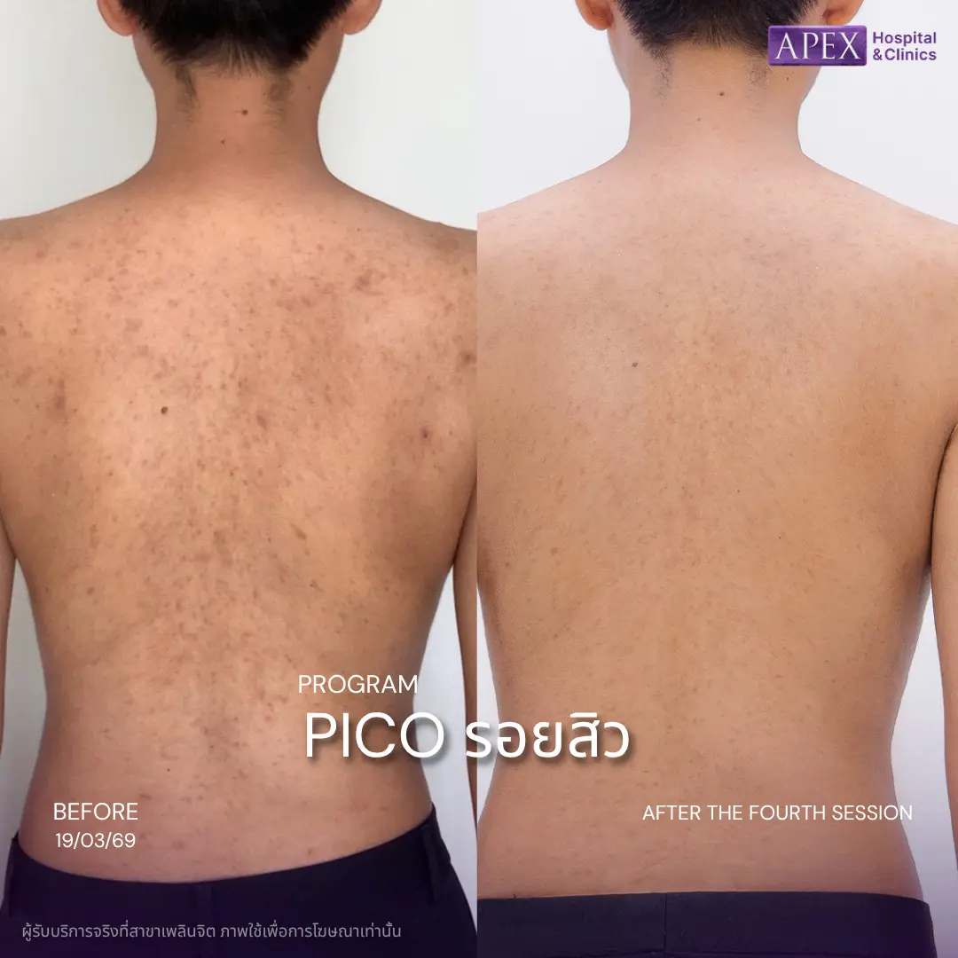 PICO Laser ลดรอยสิว ให้ผิวเนียน