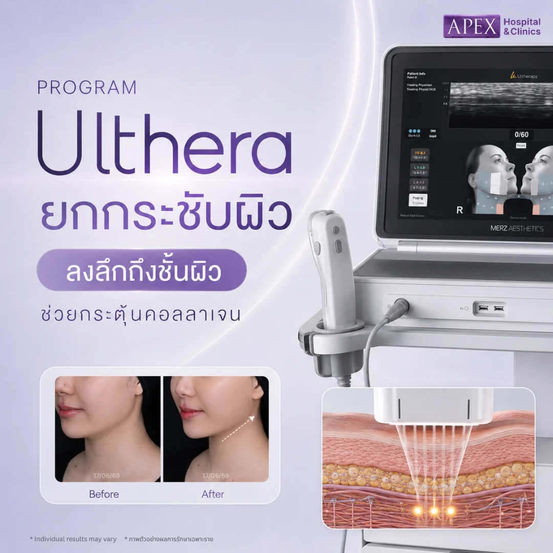Ulthera