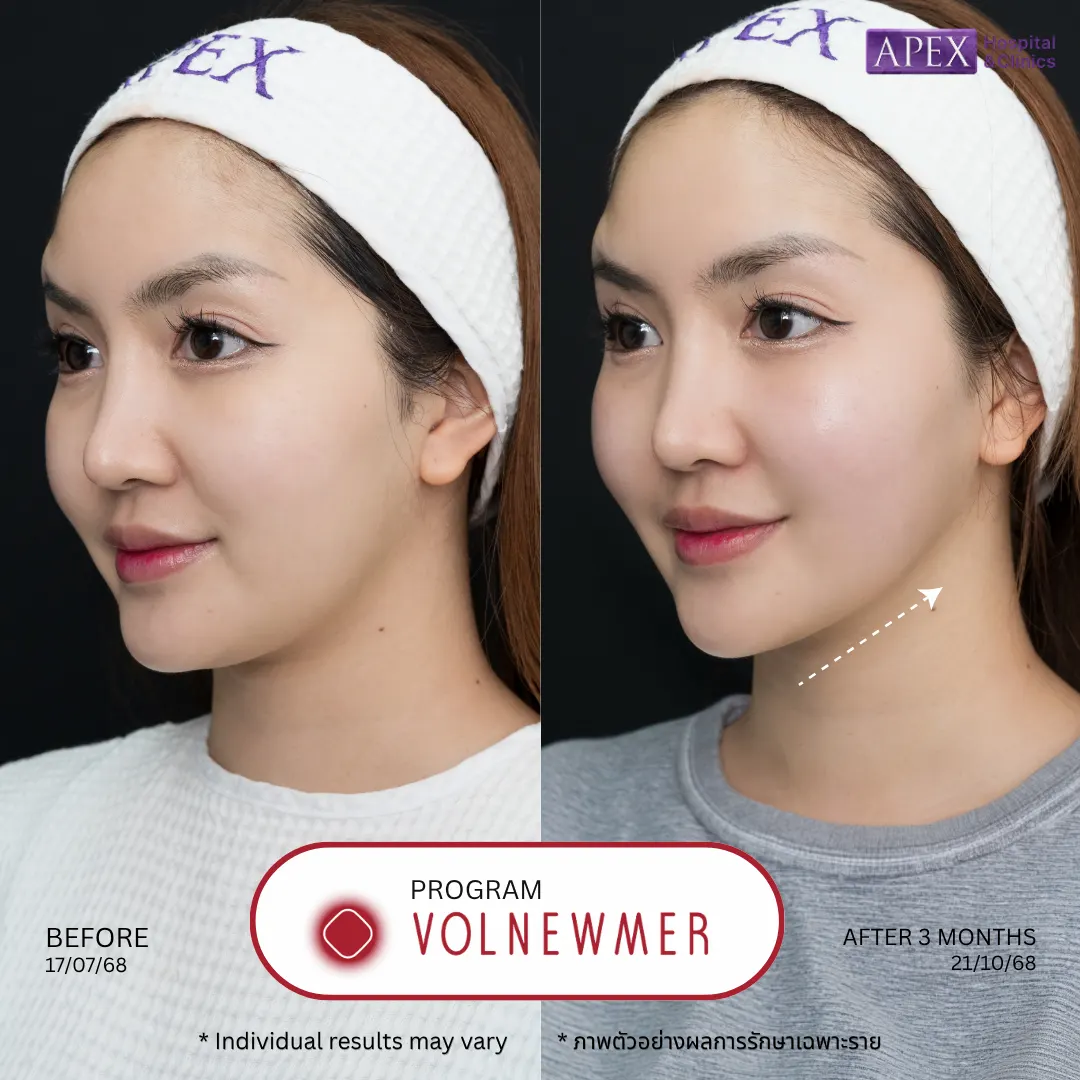 รีวิว Volnewmer vs Ultraformer