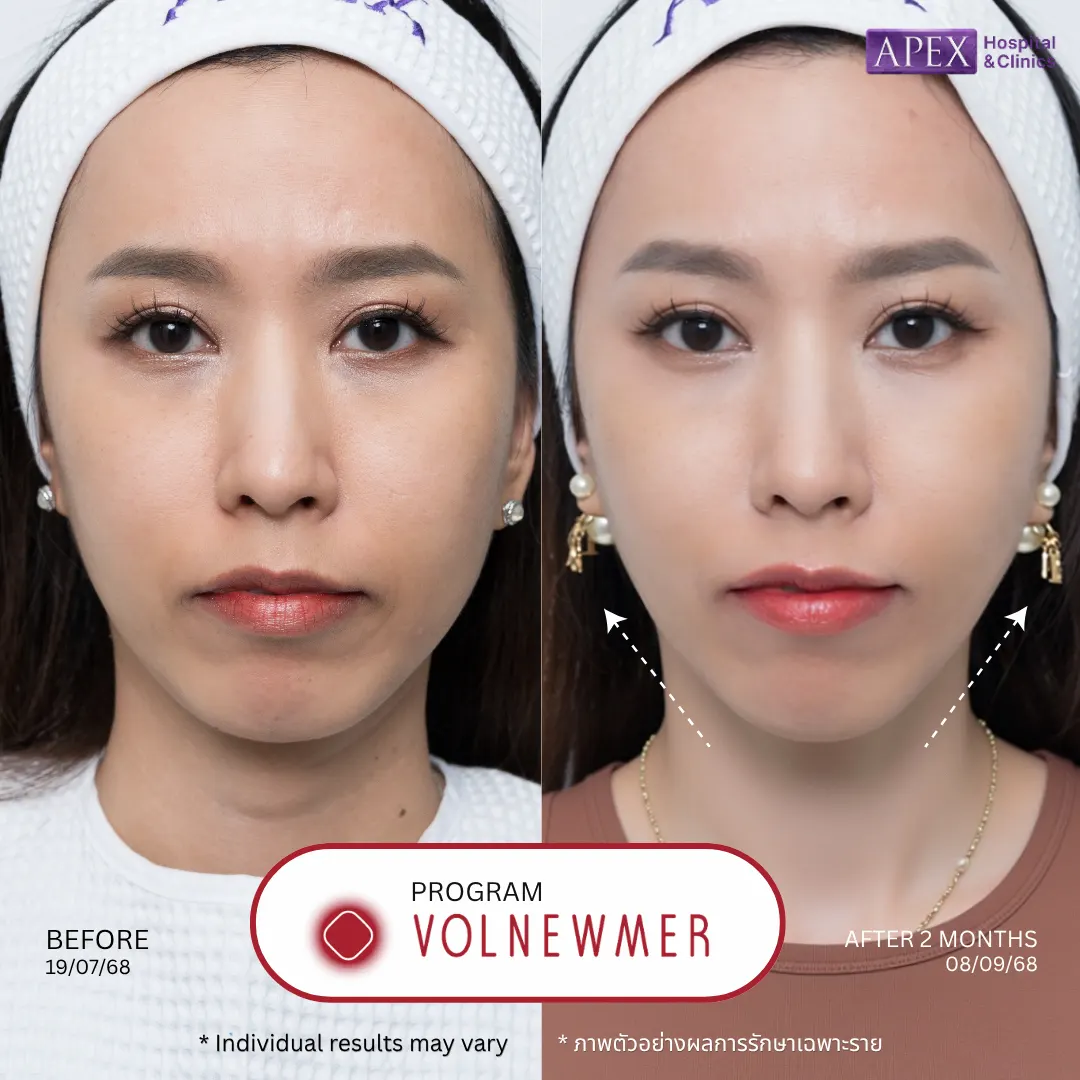 รีวิว Volnewmer vs Ultraformer