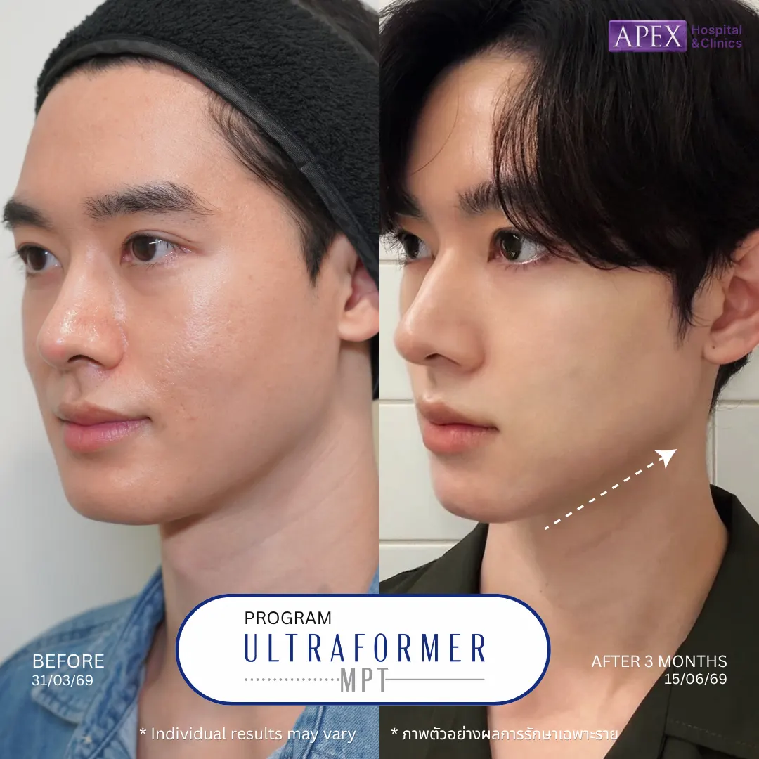 รีวิว Volnewmer vs Ultraformer