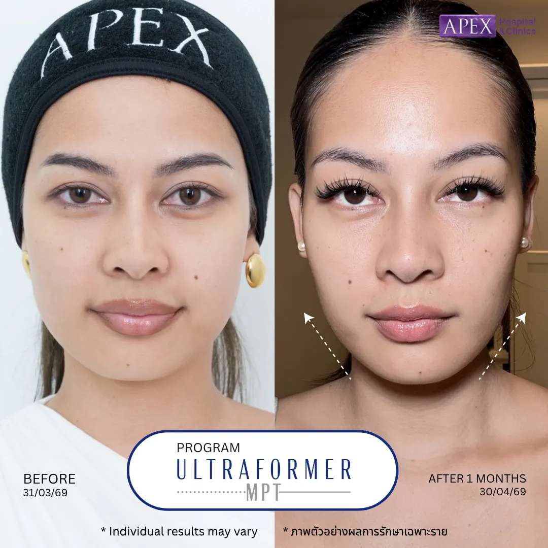 รีวิว Volnewmer vs Ultraformer