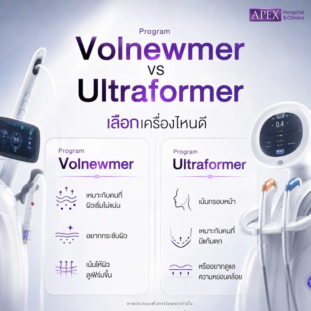 Volnewmer vs Ultraformer