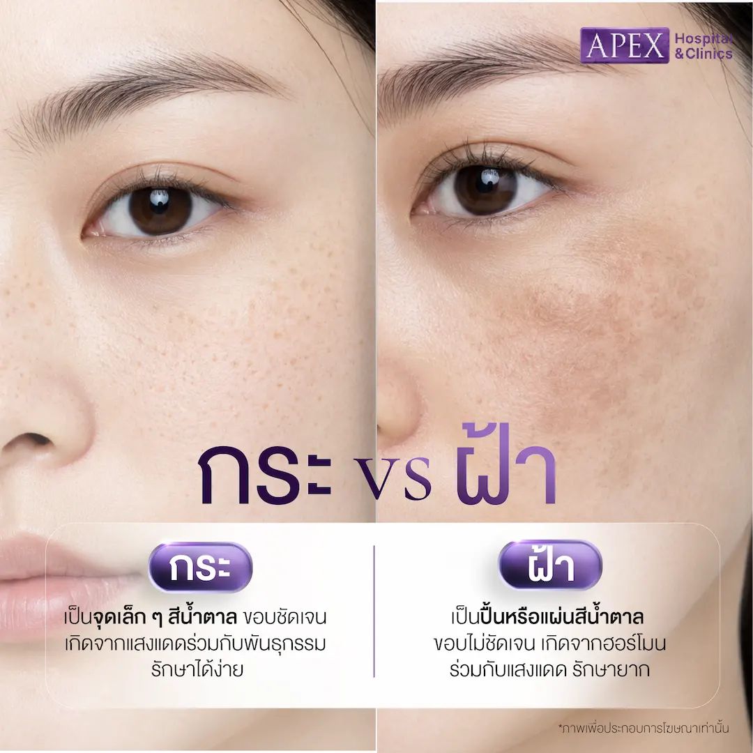 กระ vs ฝ้า ต่างกันอย่างไร