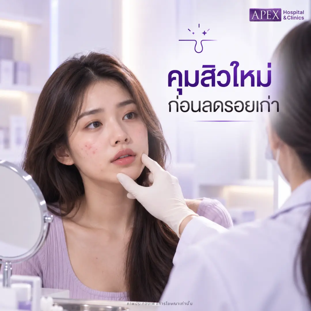คุมสิวใหม่ ก่อนลดรอยเก่า