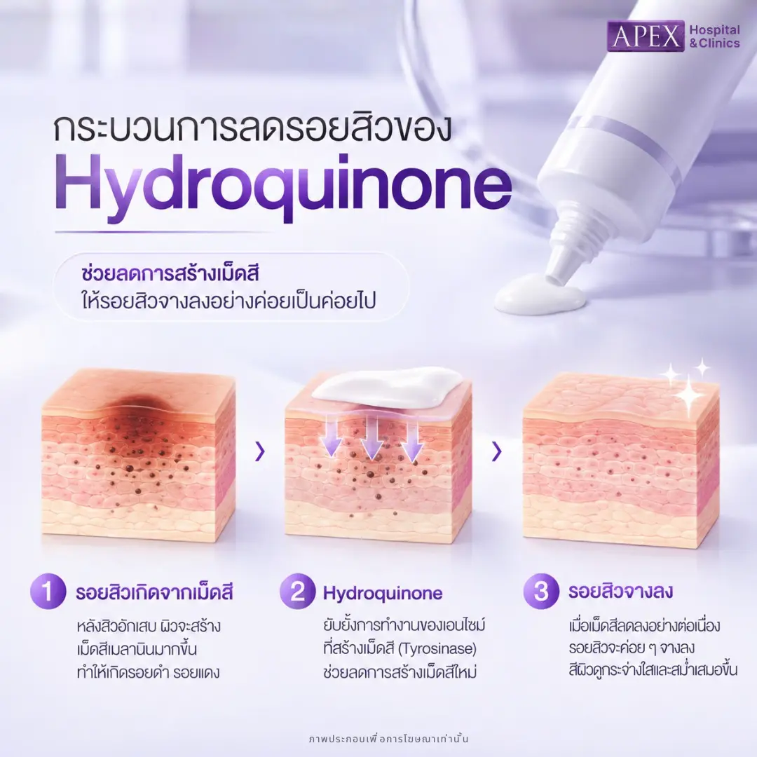 รอยดำชัดใช้ Hydroquinone