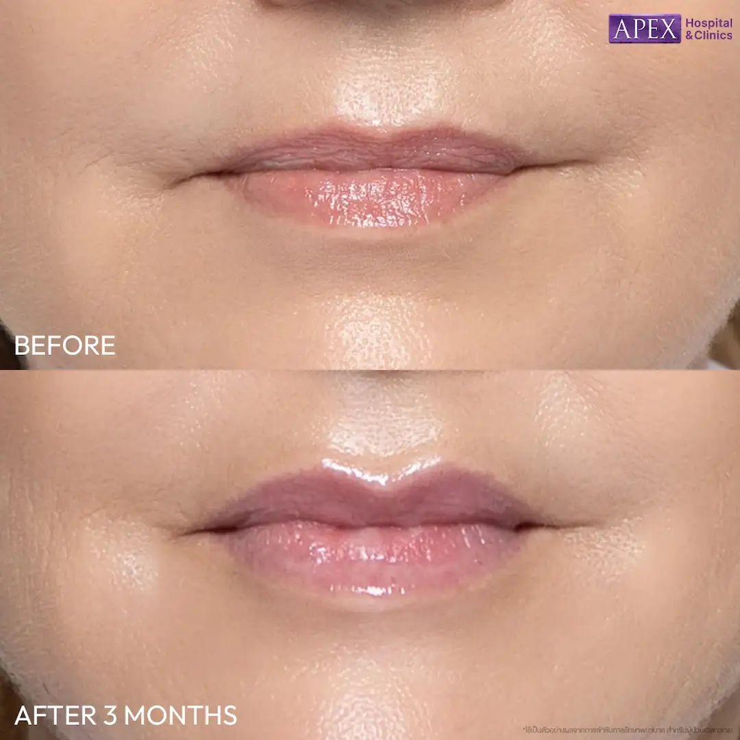 รีวิวฟิลเลอร์ Definisse