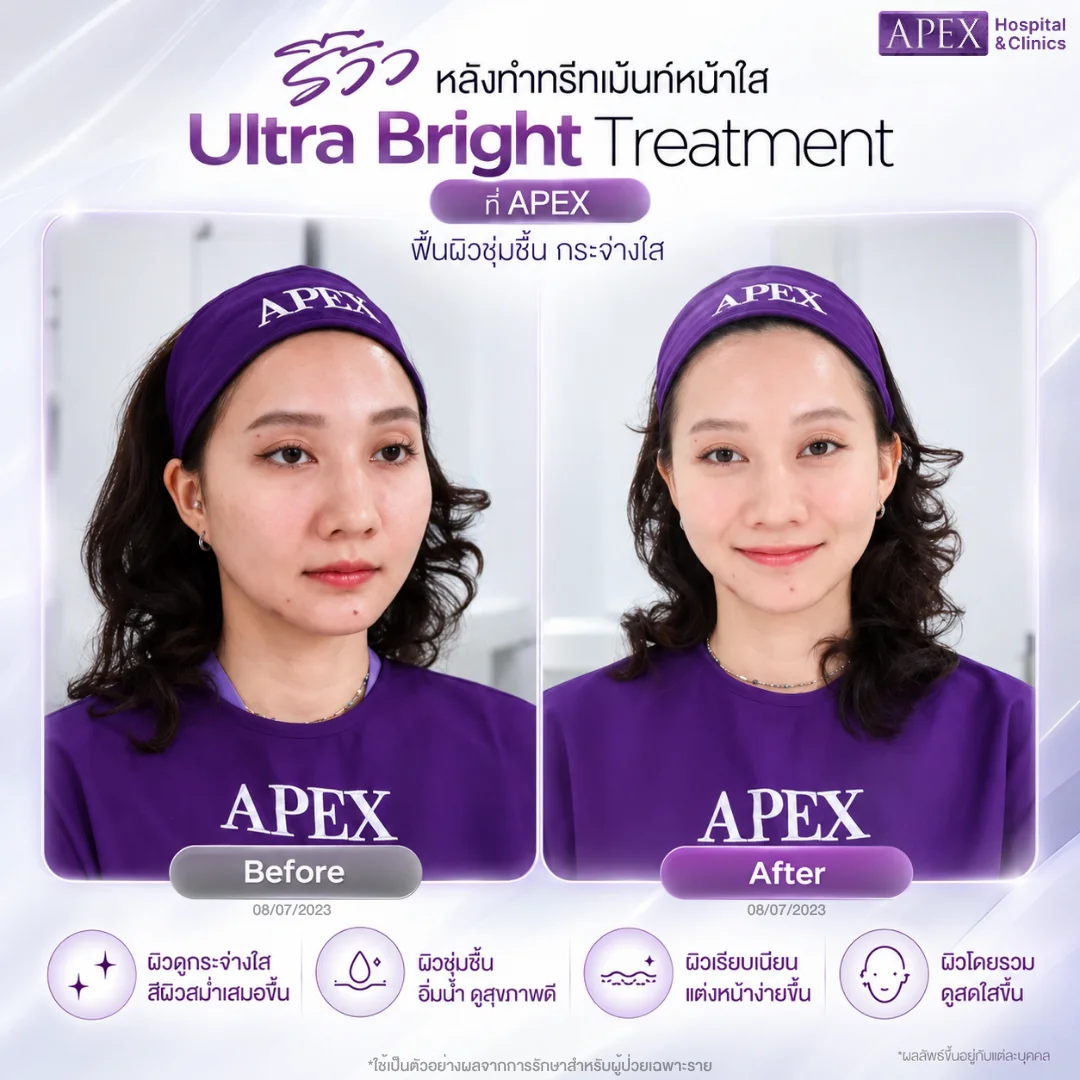 รีวิวหลังทำทรีทเม้นท์หน้าใส Ultra Bright ที่ APEX