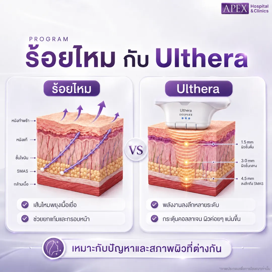 รู้จักร้อยไหม กับ Ulthera