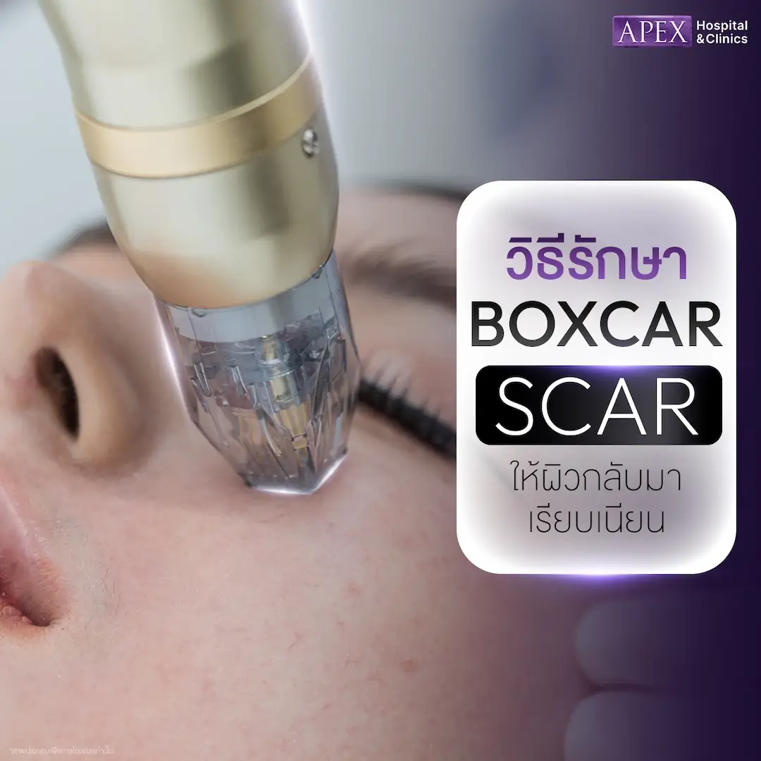 วิธีรักษา Boxcar Scar มีอะไรบ้าง