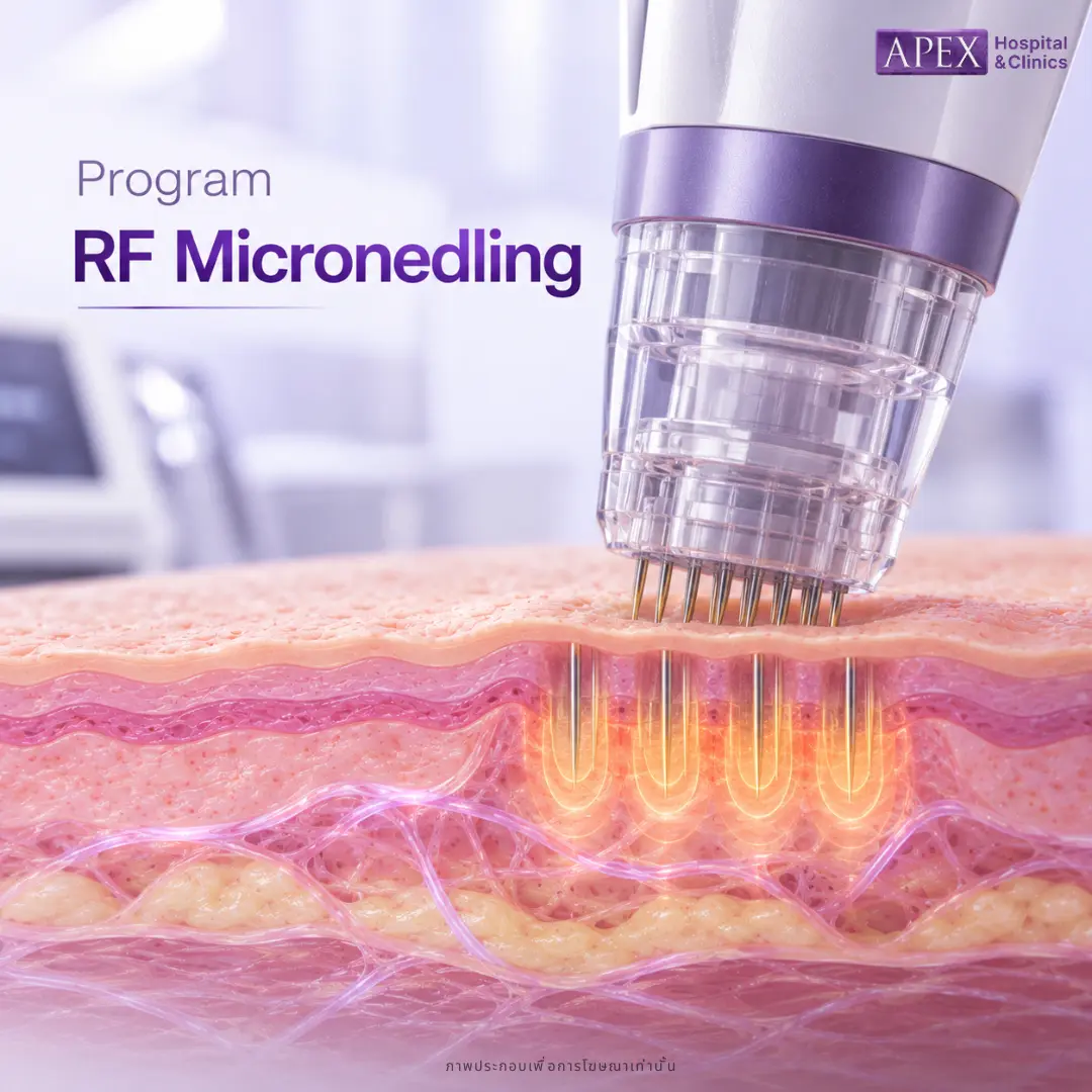 หลุมตื้นถึงปานกลาง ใช้ Microneedling