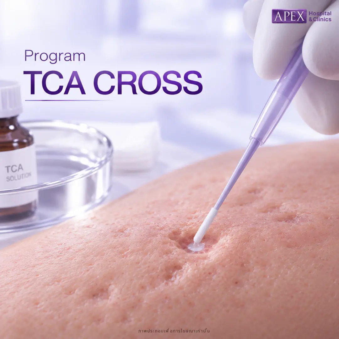 หลุมเล็กแต่ลึก ใช้ TCA CROSS